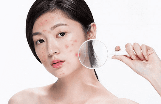 Cách Chăm Sóc Da Mụn Ngày Đèn Đỏ Không Để Lại Thâm Mụn
